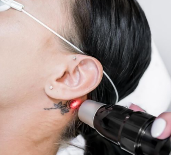 Profesionalni laser PicoIris® - Slika 3